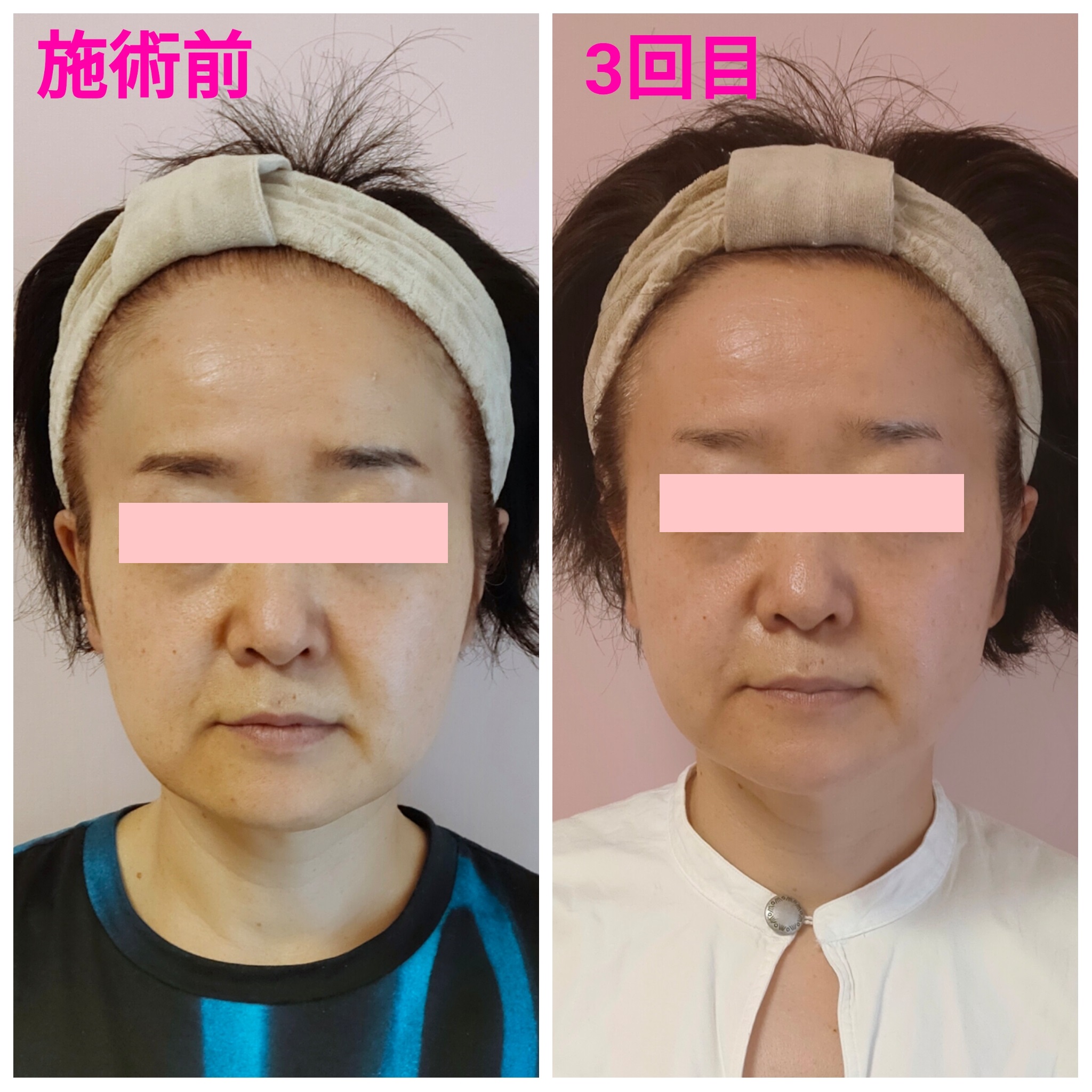 BeforeAfter画像