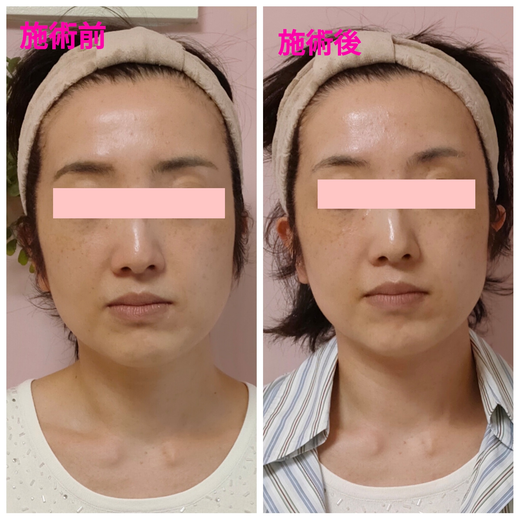 BeforeAfter画像